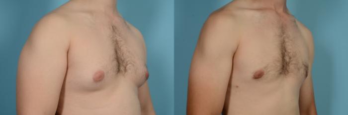 Before & After Male Breast Reduction (Gynecomastia) by Dr. Mustoe Case 630 Right Oblique View in Chicago, IL