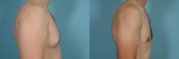 Before & After Male Breast Reduction (Gynecomastia) by Dr. Mustoe Case 630 Right Side View in Chicago, IL