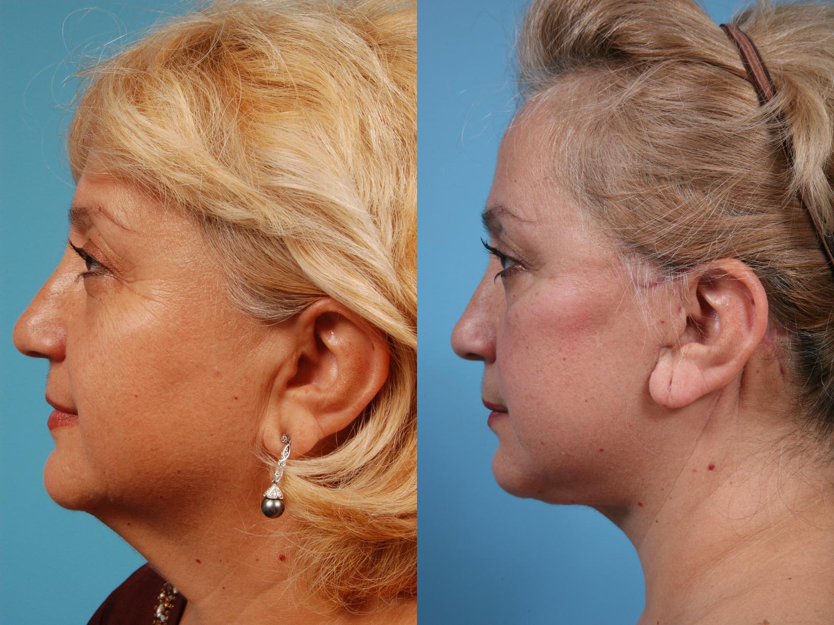 Neck Lift Before and After Pictures Case 142 Chicago, IL TLKM