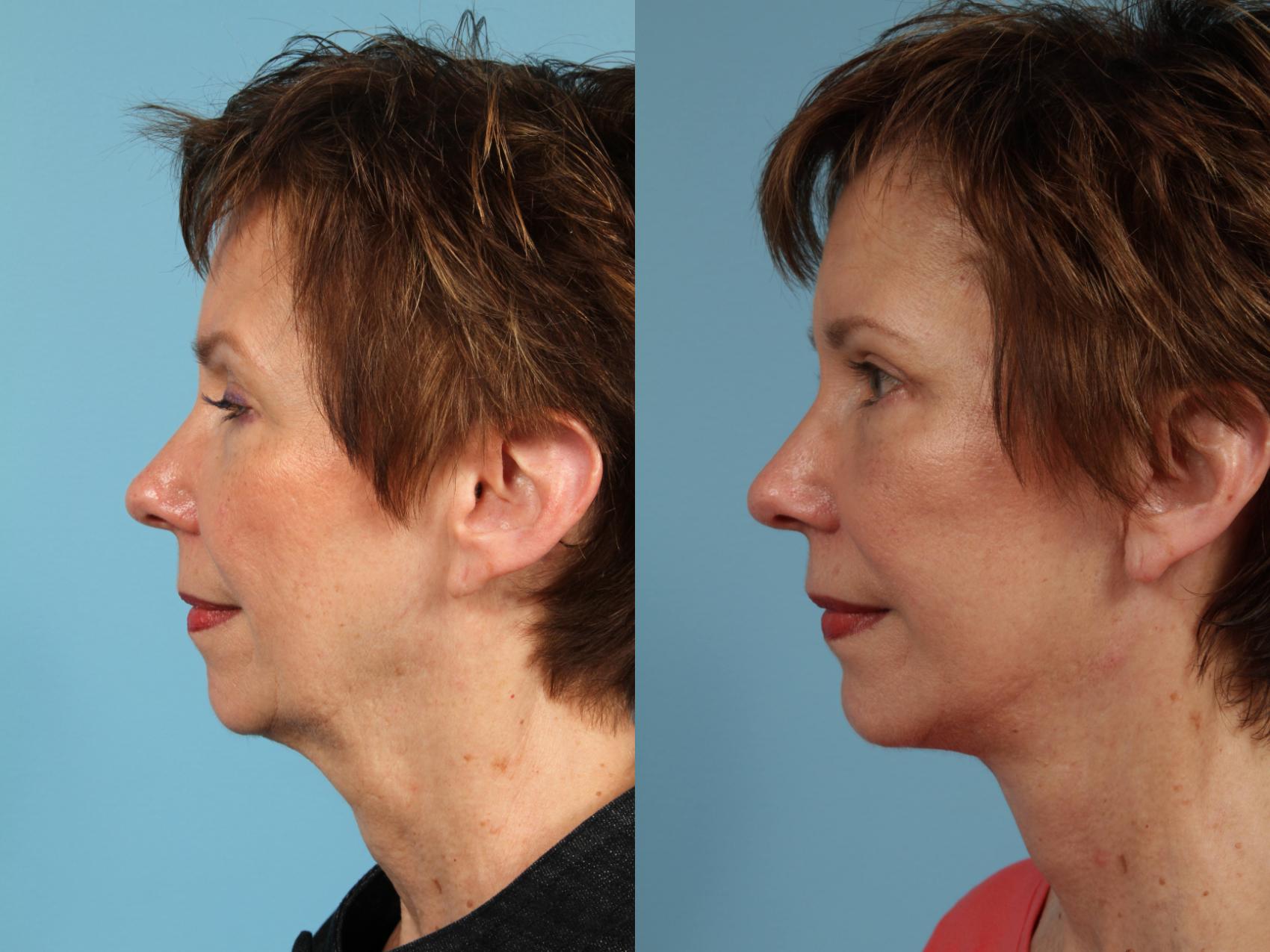 Before & After Neck Lift Case 143 View #1 View in Chicago, IL