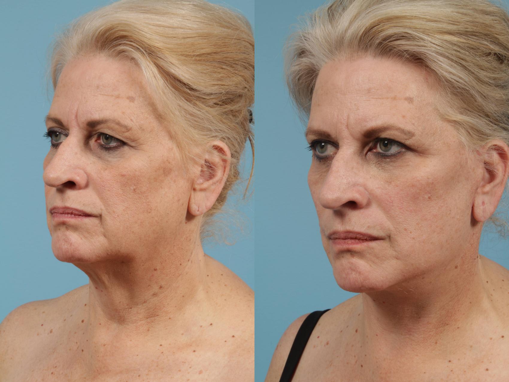 Neck Lift Before And After Pictures Case 154 | Chicago, IL | TLKM ...