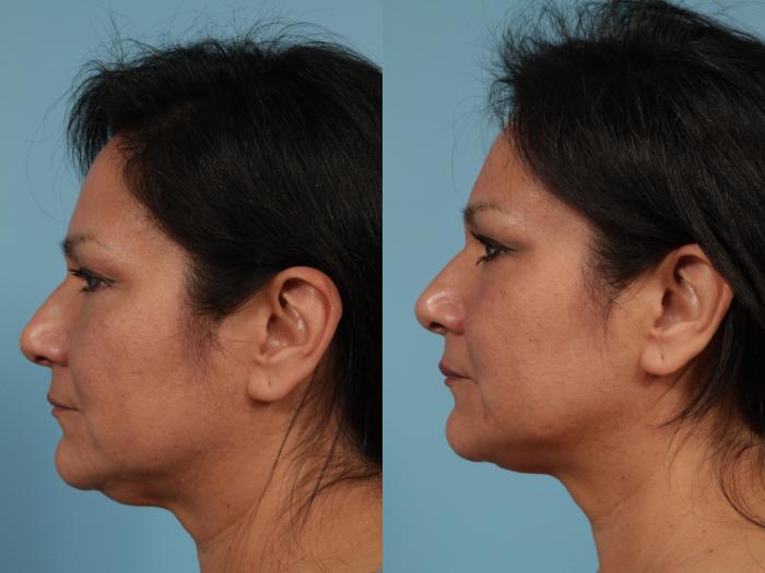 Before & After Neck Lift Case 227 View #1 View in Chicago, IL
