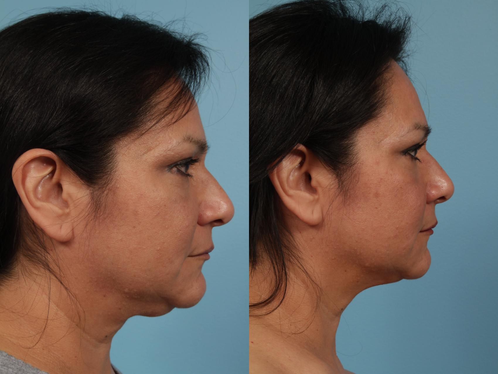 Before & After Neck Lift Case 227 View #2 View in Chicago, IL