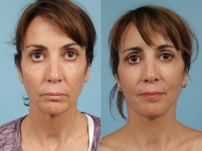 Before & After Neck Lift Case 257 View #3 View in Chicago, IL