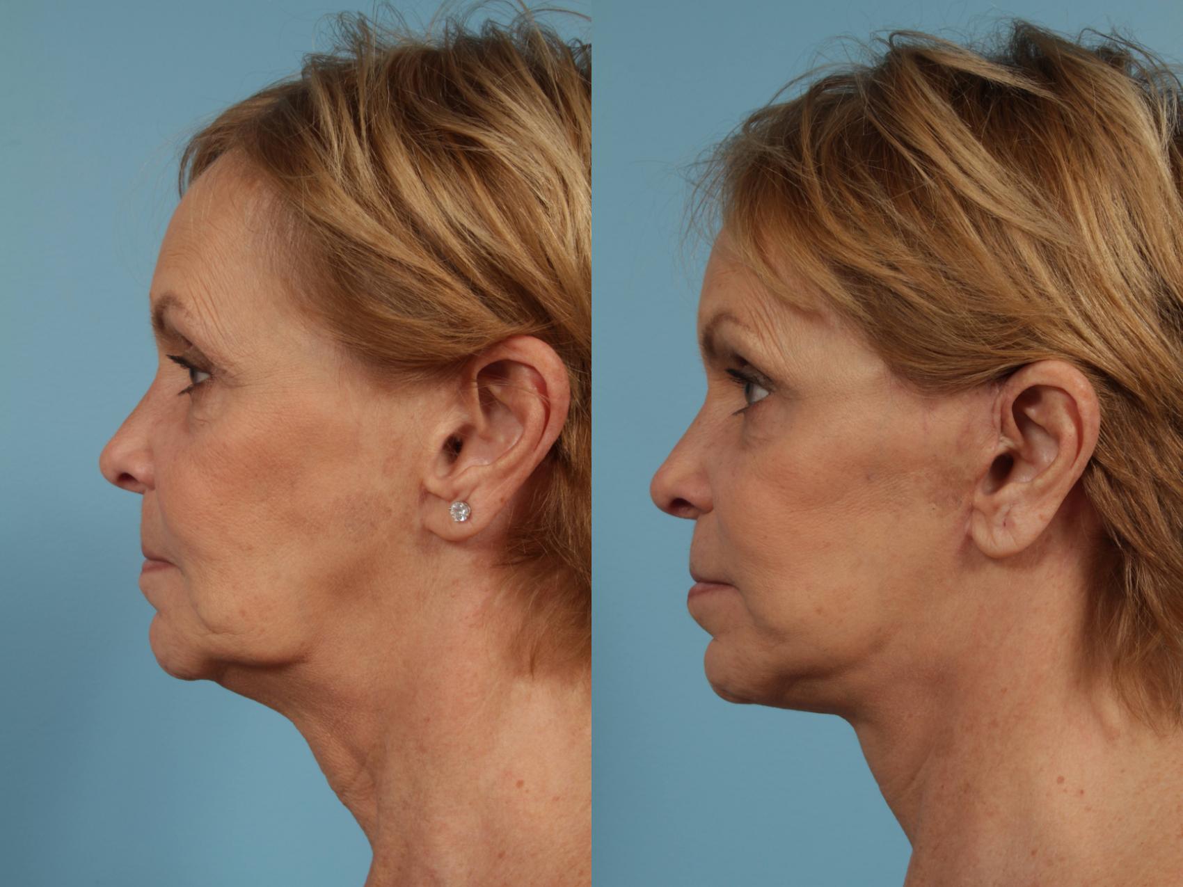 Before & After Neck Lift Case 268 View #1 View in Chicago, IL