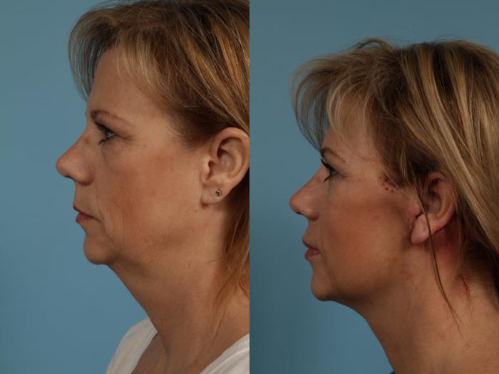 Before & After Neck Lift Case 275 View #1 View in Chicago, IL