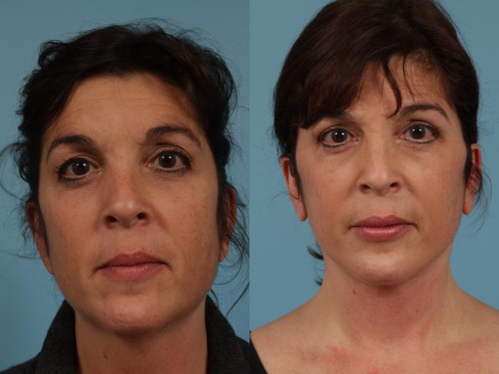 Before & After Neck Lift Case 332 View #1 View in Chicago, IL