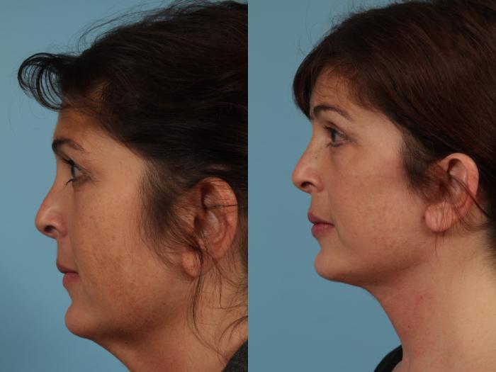 Before & After Neck Lift by Dr. Mustoe Case 332 View #2 View in Chicago, IL