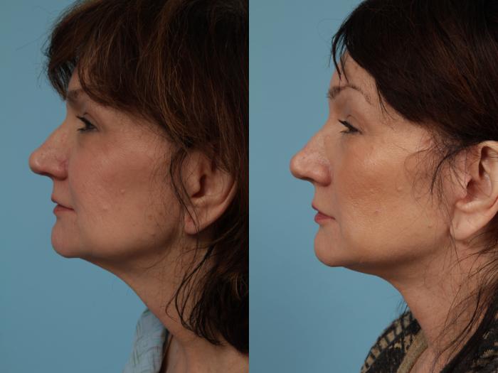 Before & After Neck Lift Case 336 View #1 View in Chicago, IL