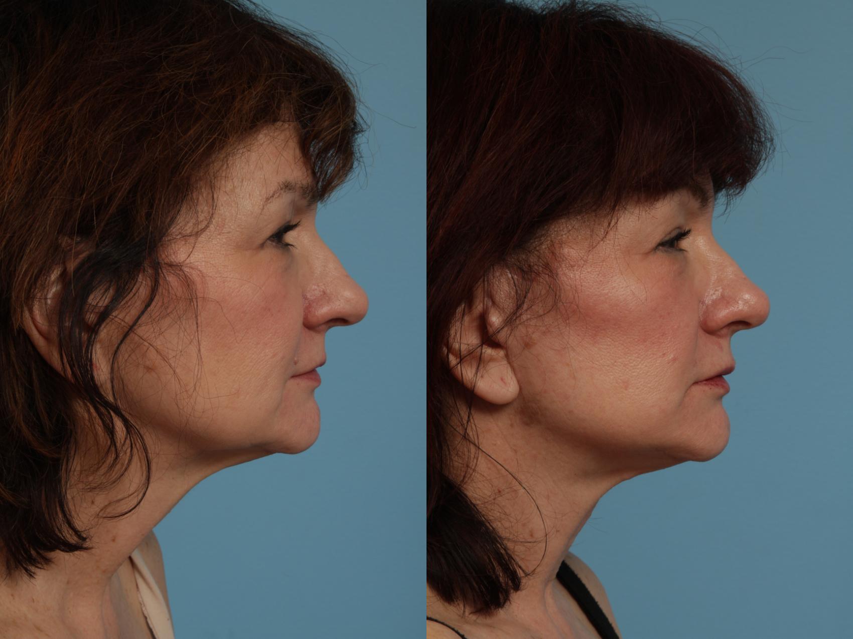 Before & After Neck Lift Case 336 View #2 View in Chicago, IL