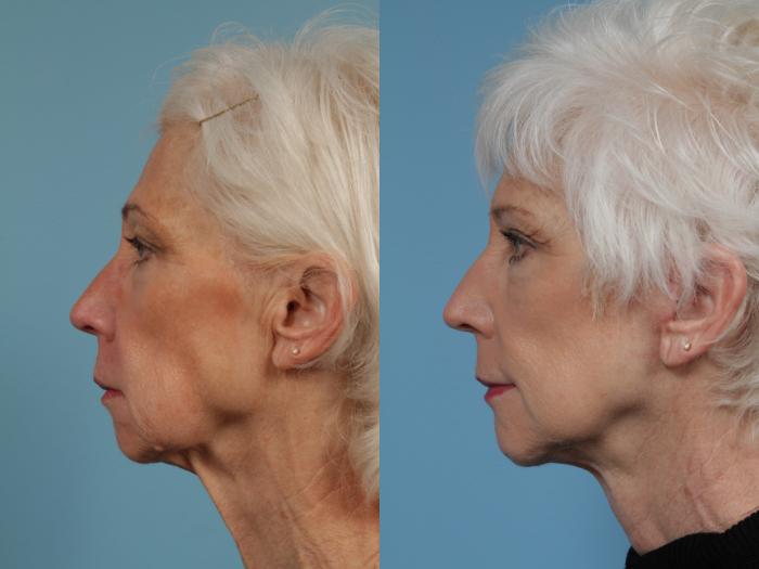 Before & After Neck Lift Case 350 View #1 View in Chicago, IL