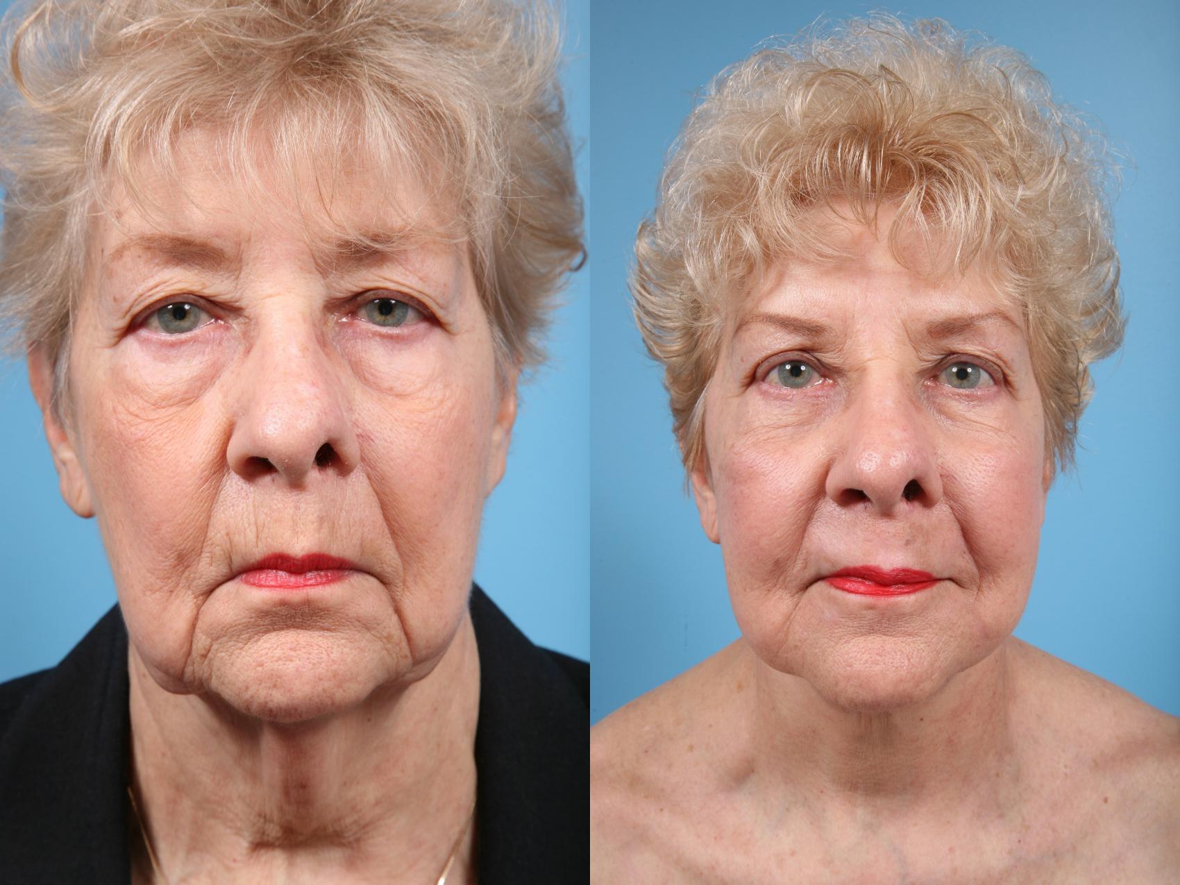 Neck Lift Before And After Photos Patient 67 Chicago Il Tlkm Plastic
