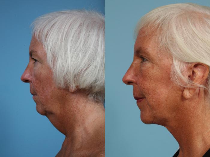 Before & After Neck Lift Case 88 View #1 View in Chicago, IL