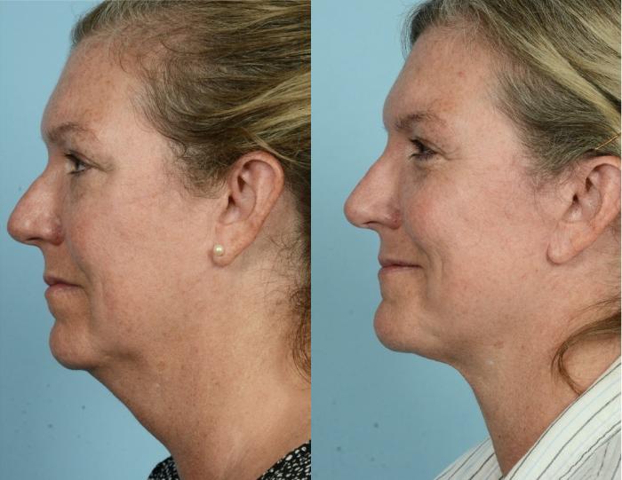 Before & After Rhinoplasty by Dr. Mustoe Case 888 Left Side View in Chicago, IL