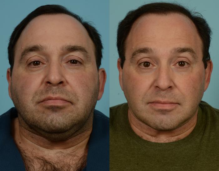 Before & After Neck Lift by Dr. Mustoe Case 1002 Front View in Chicago, IL