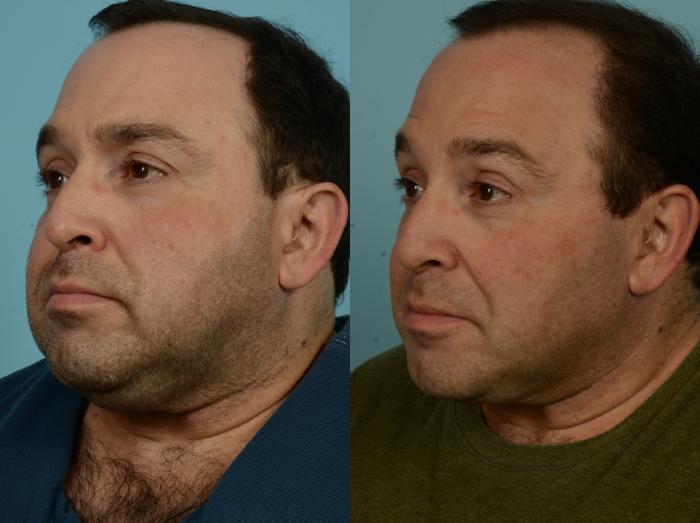 Before & After Neck Lift by Dr. Mustoe Case 1002 Left Oblique View in Chicago, IL