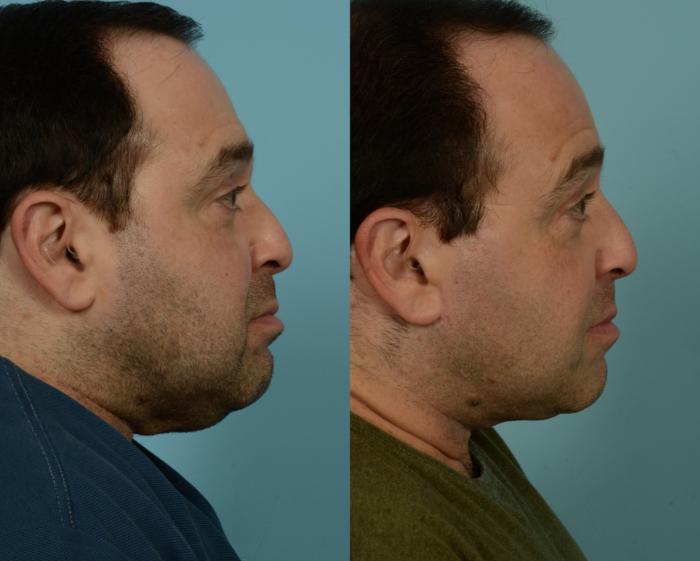 Before & After Neck Lift by Dr. Mustoe Case 1002 Right Side View in Chicago, IL