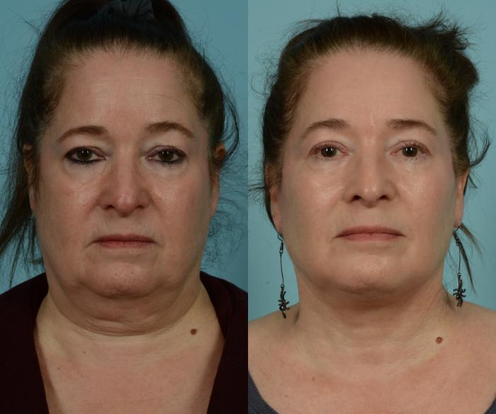 Before & After Neck Lift by Dr. Mustoe Case 1015 Front View in Chicago, IL