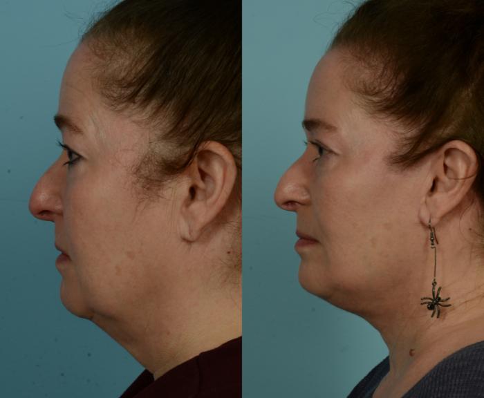 Before & After Neck Lift by Dr. Mustoe Case 1015 Left Side View in Chicago, IL