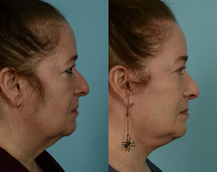 Before & After Neck Lift by Dr. Mustoe Case 1015 Right Side View in Chicago, IL