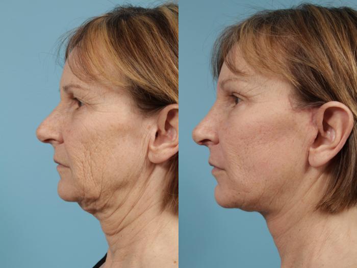 Before & After Neck Lift by Dr. Mustoe Case 140 View #1 View in Chicago, IL