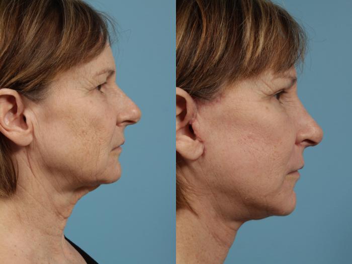 Before & After Neck Lift by Dr. Mustoe Case 140 View #2 View in Chicago, IL
