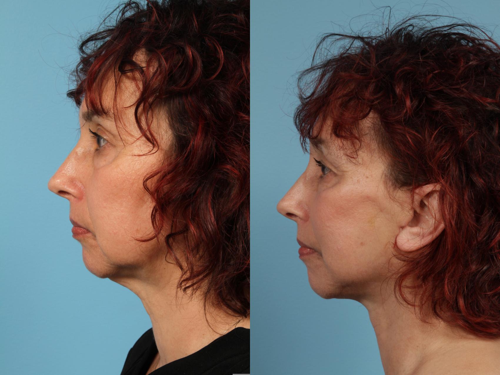 Before & After Neck Lift by Dr. Mustoe Case 141 View #1 View in Chicago, IL