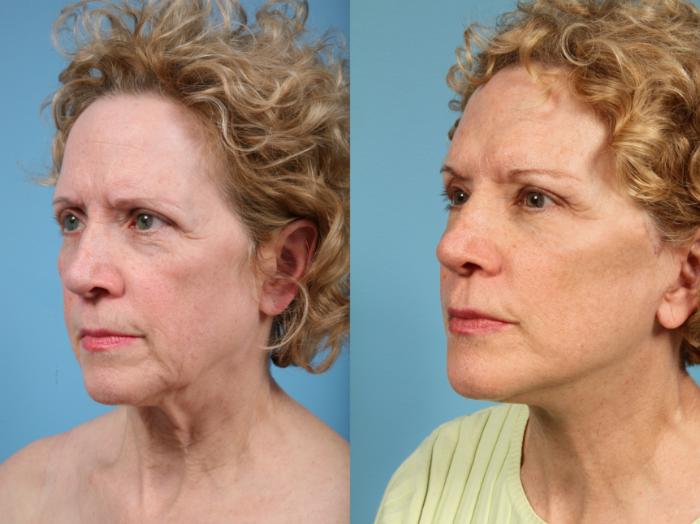 Before & After Deep Plane Facelift by Dr. Mustoe Case 144 Left Oblique View in Chicago, IL