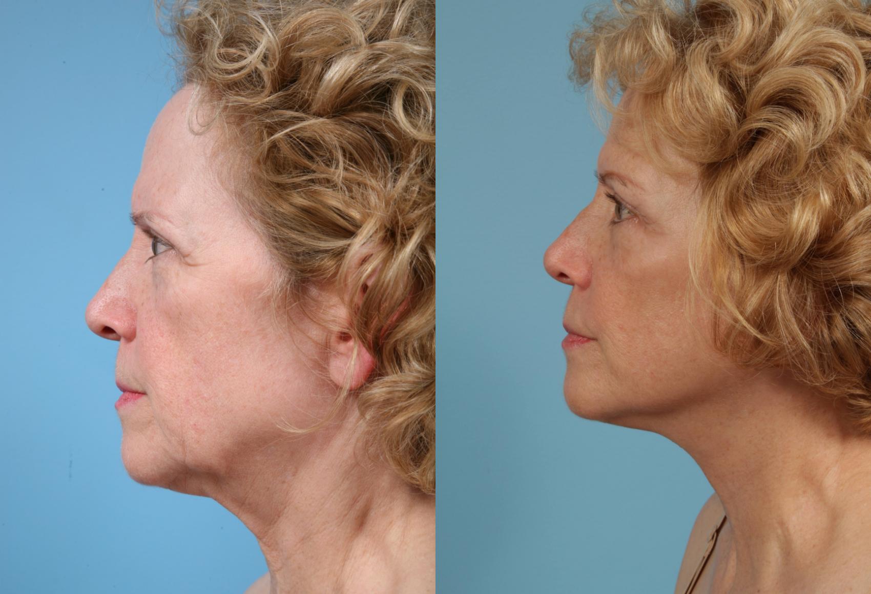Before & After Neck Lift by Dr. Mustoe Case 144 Left Side View in Chicago, IL