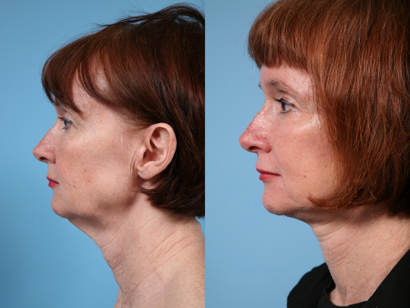 Before & After Neck Lift by Dr. Mustoe Case 145 View #1 View in Chicago, IL