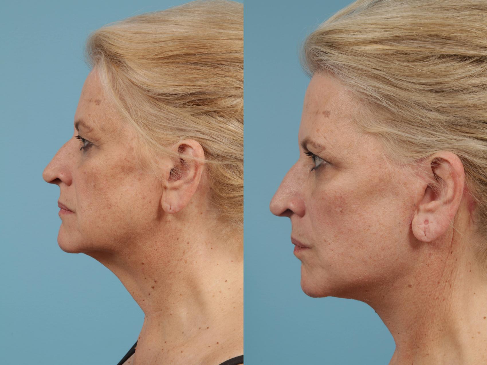 Before & After Neck Lift by Dr. Mustoe Case 154 View #1 View in Chicago, IL