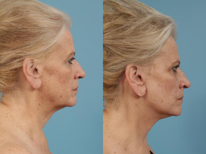 Before & After Neck Lift by Dr. Mustoe Case 154 View #3 View in Chicago, IL