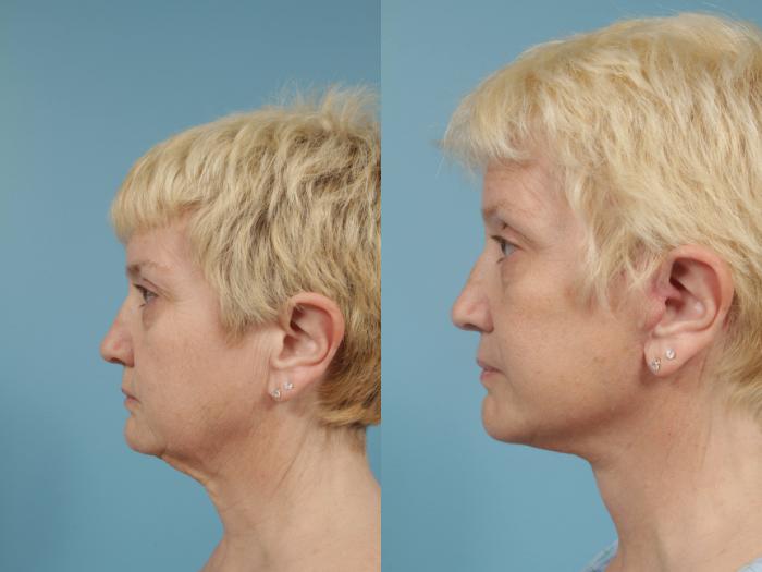 Before & After Neck Lift by Dr. Mustoe Case 171 View #2 View in Chicago, IL