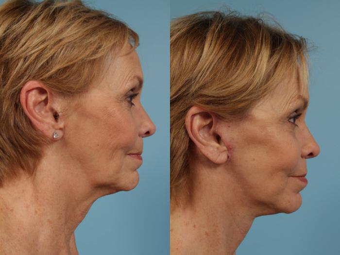 Before & After Neck Lift by Dr. Mustoe Case 268 View #2 View in Chicago, IL