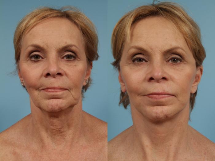 Before & After Neck Lift by Dr. Mustoe Case 268 View #3 View in Chicago, IL