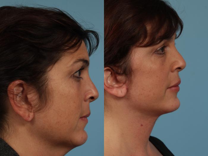 Before & After Neck Lift by Dr. Mustoe Case 332 View #3 View in Chicago, IL