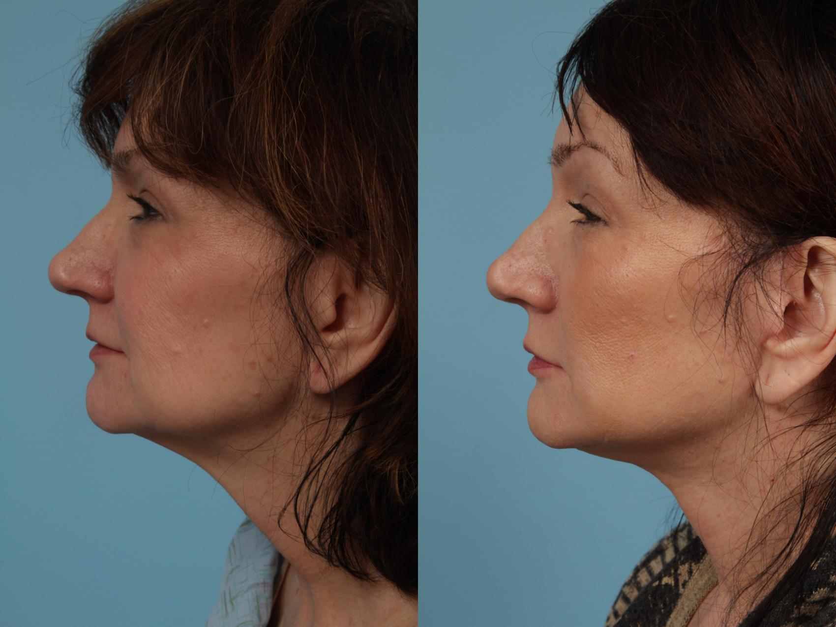 Before & After Neck Lift by Dr. Mustoe Case 336 View #1 View in Chicago, IL