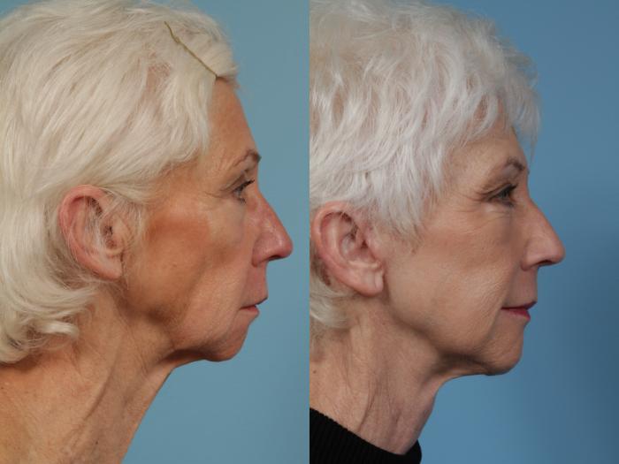 Before & After Neck Lift by Dr. Mustoe Case 350 View #2 View in Chicago, IL