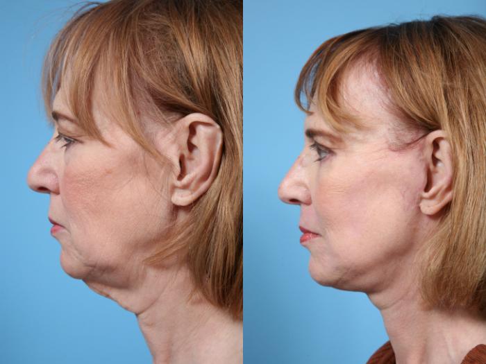 Before & After Neck Lift by Dr. Mustoe Case 68 View #1 View in Chicago, IL