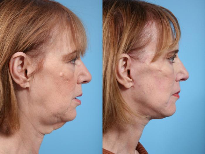 Before & After Neck Lift by Dr. Mustoe Case 68 View #2 View in Chicago, IL