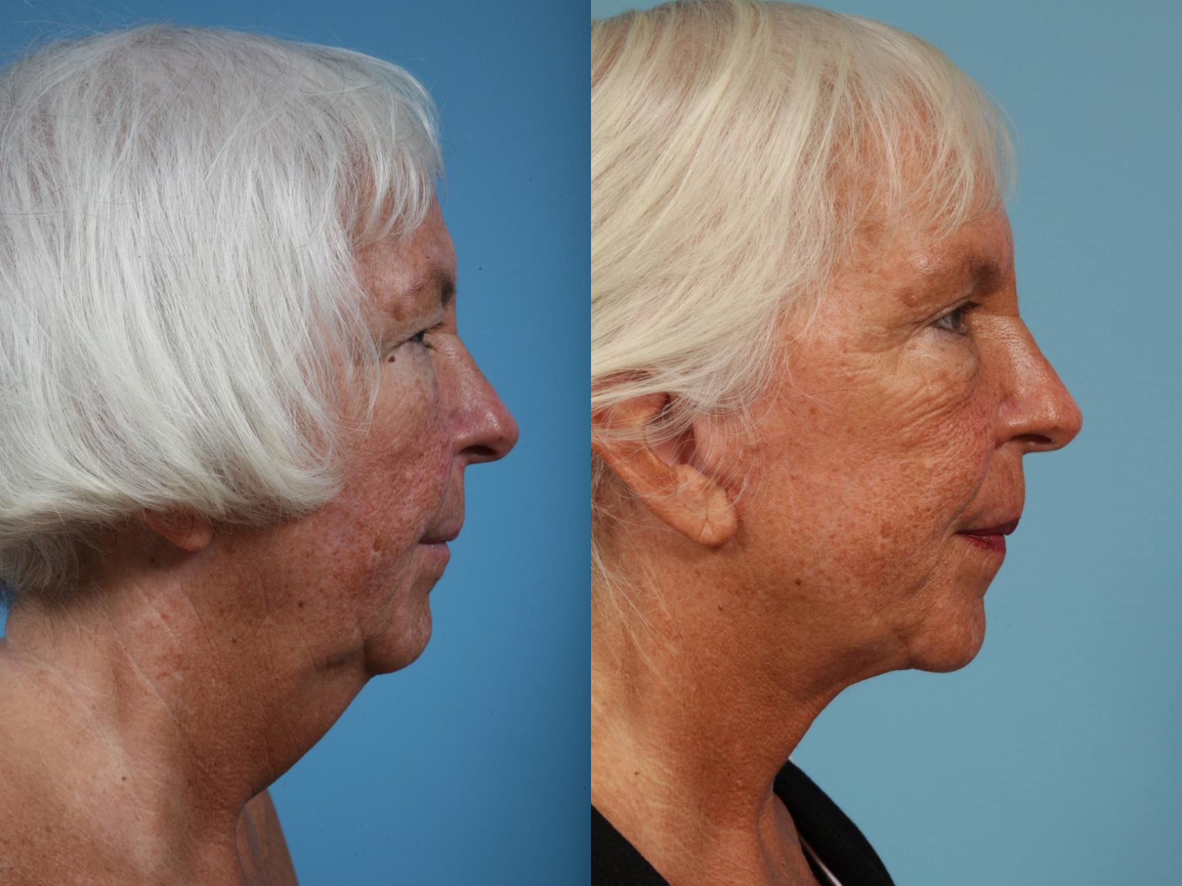 Before & After Neck Lift by Dr. Mustoe Case 88 View #2 View in Chicago, IL