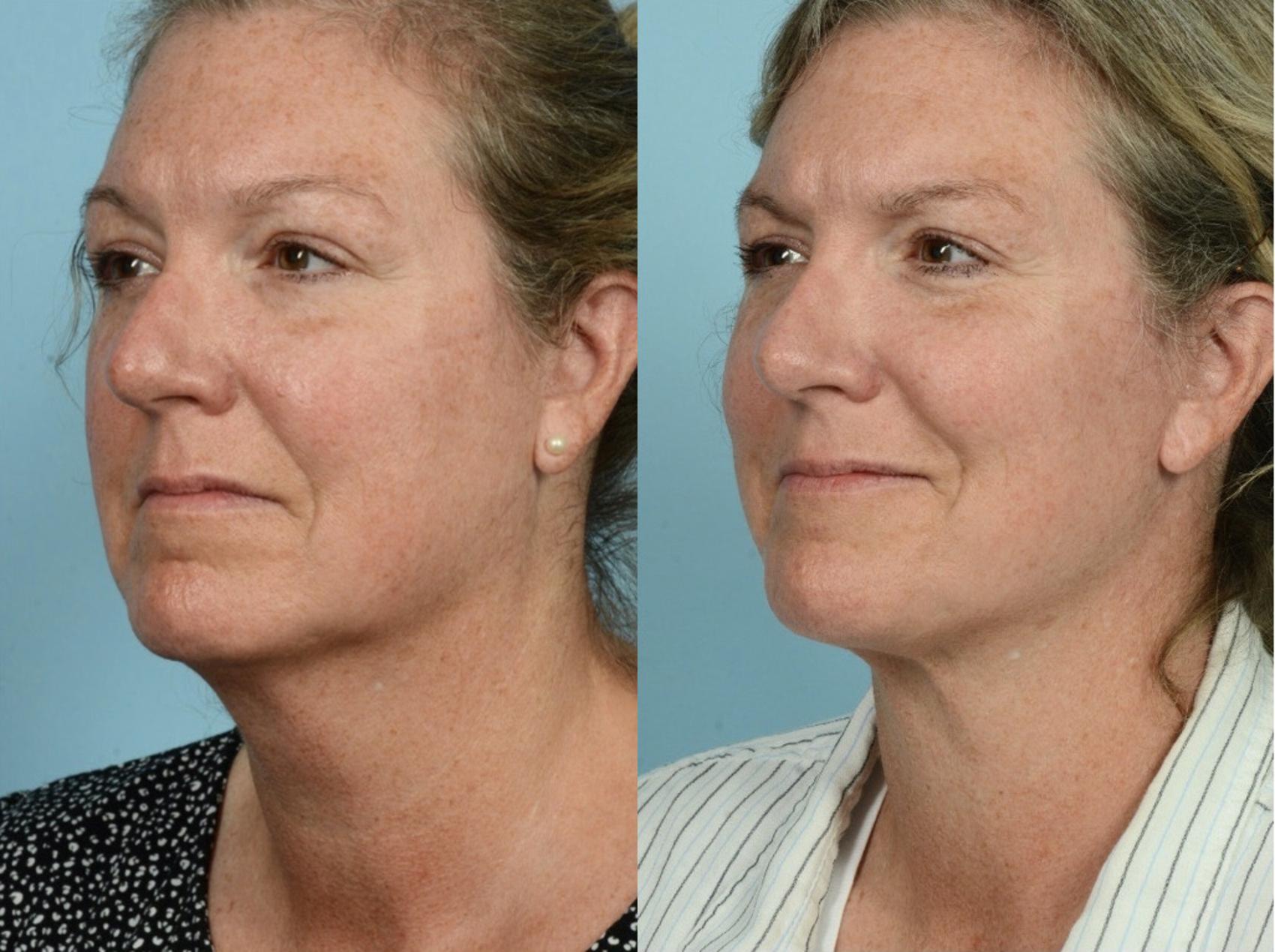 Before & After Neck Lift by Dr. Mustoe Case 888 Left Oblique View in Chicago, IL