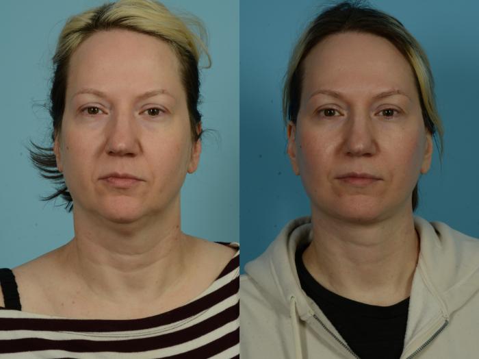 Before & After Neck Lift by Dr. Sinno Case 1038 Front View in Chicago, IL