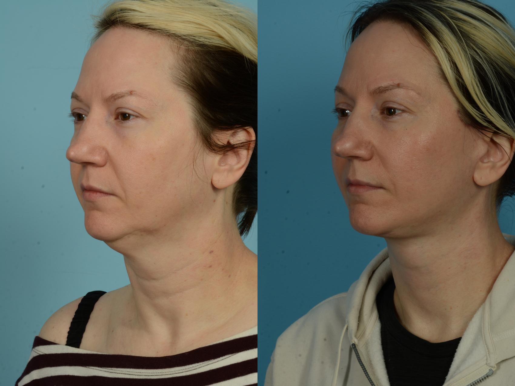 Before & After Neck Lift by Dr. Sinno Case 1038 Left Oblique View in Chicago, IL