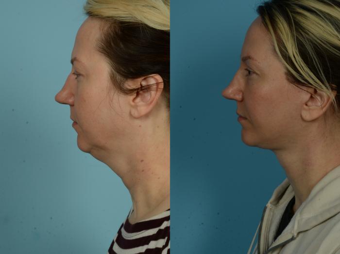 Before & After Neck Lift by Dr. Sinno Case 1038 Left Side View in Chicago, IL