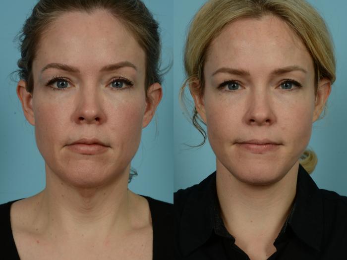 Before & After Neck Lift by Dr. Sinno Case 830 Front View in Chicago, IL