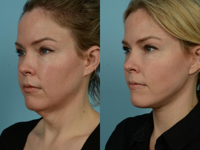 Before & After Neck Lift by Dr. Sinno Case 830 Left Oblique View in Chicago, IL