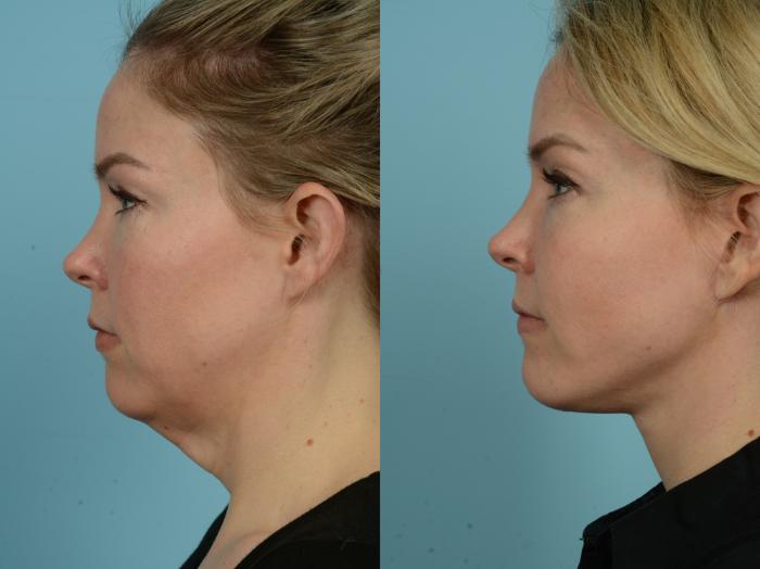 Before & After Neck Lift by Dr. Sinno Case 830 Left Side View in Chicago, IL