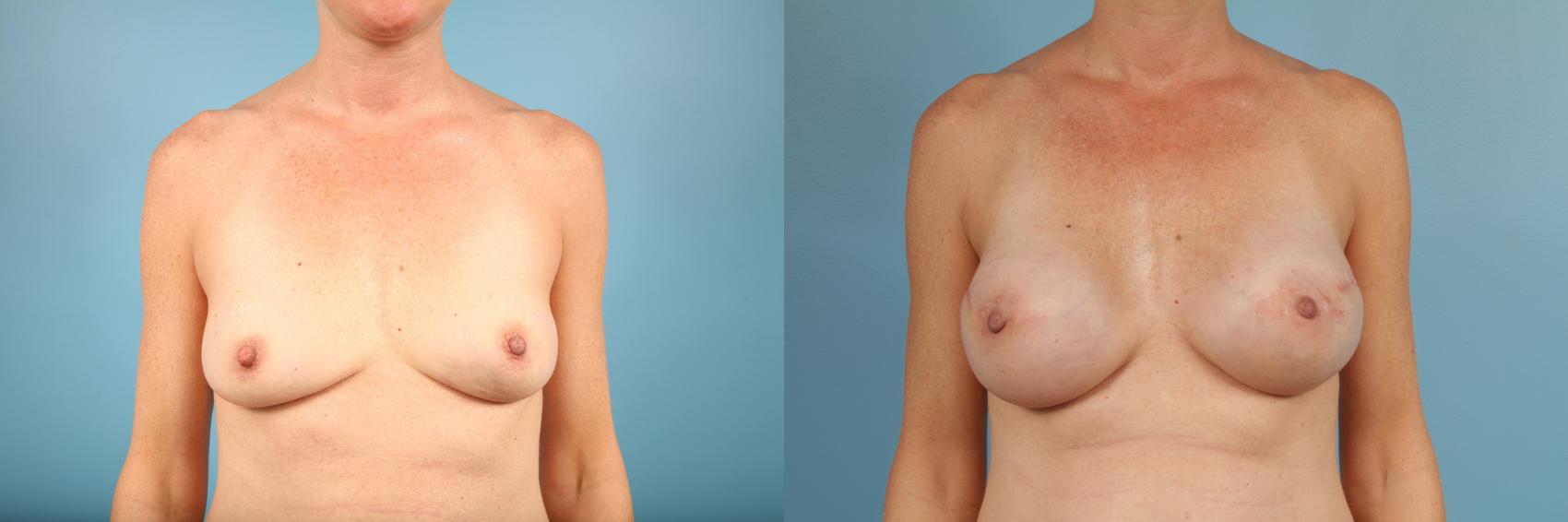 Before & After Nipple Sparing Mastectomy Case 100 View #1 View in Chicago, IL