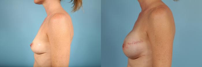 Before & After Nipple Sparing Mastectomy Case 100 View #2 View in Chicago, IL
